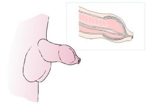 phimosis