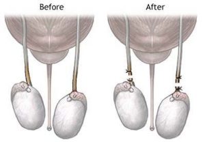 A vasectomy is one form of permanent birth control.