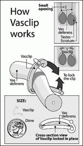 A Vasclip can be used in lieu of cutting and suturing or cauterizing the vas deferens.