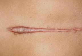 penis surgery keloid scar