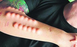 australian prisoners implant stuff in their penis