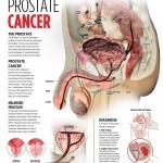 prostate cancer