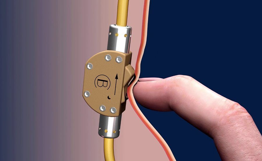 bimek birth control switch