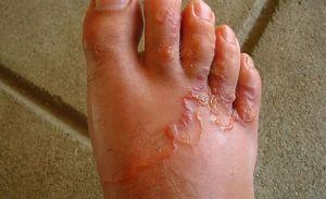 hookworm