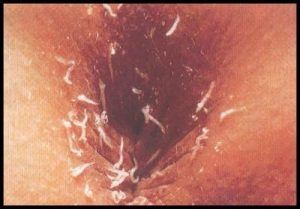 pinworm