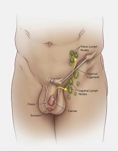 Penile Cancer lymph nodes